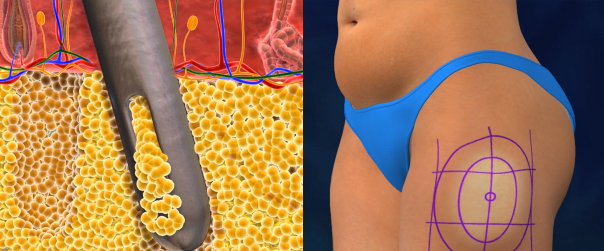 Understanding Liposuction: Costs, Risks, and Recovery Process