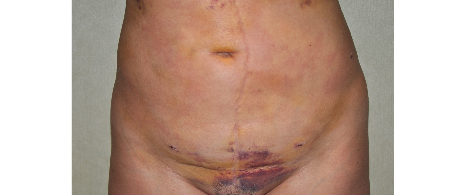 Understanding Bruising: All You Need to Know About Plastic Surgery Recovery