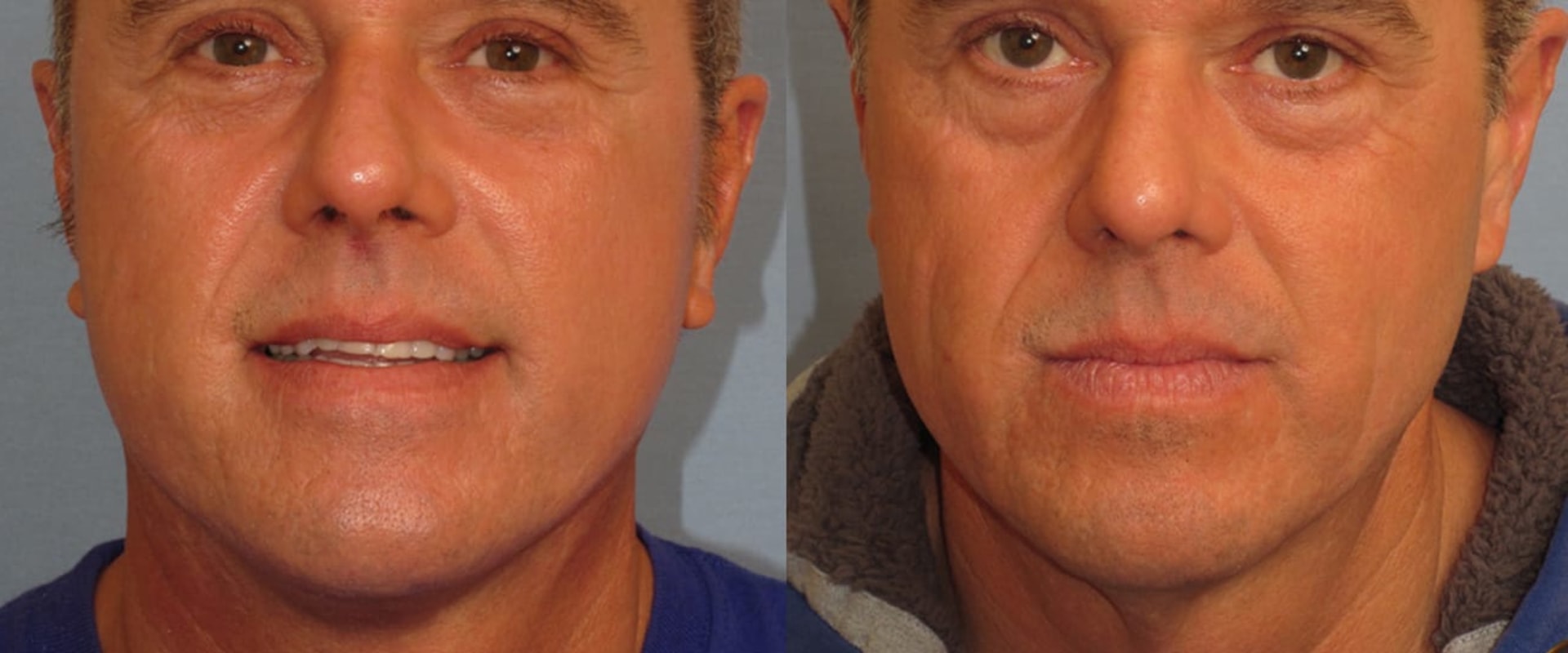 Desired Aesthetic Outcomes in Plastic Surgery for Men