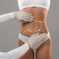 Covering All Aspects of Liposuction