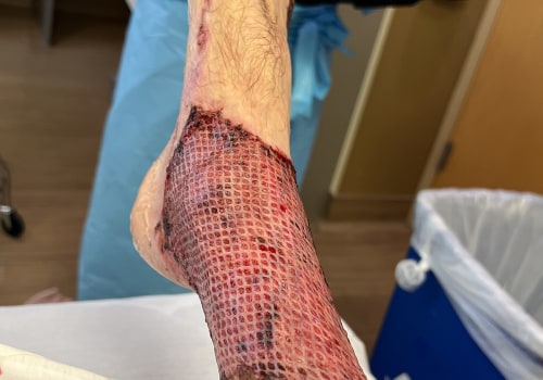 Skin Grafting: Understanding the Different Types of Plastic Surgery