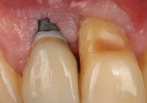 Understanding Implant Complications: What You Need to Know