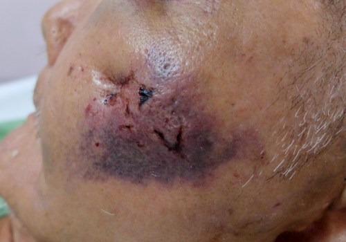 Understanding Infection: What You Need to Know About Plastic Surgery Risks